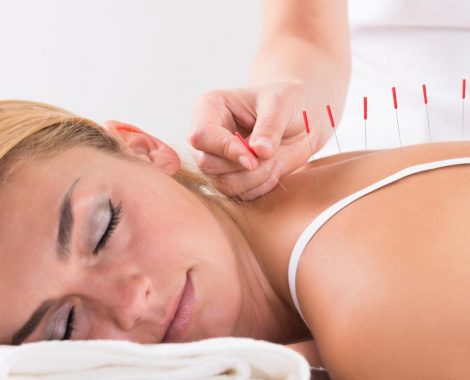 woman-being-treated-with-acupuncture